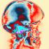 Distinción entre convulsiones y epilepsia
